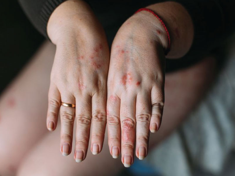 راه های درمان پسوریازیس