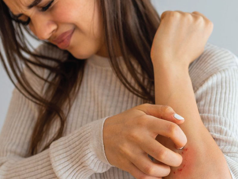 درمان پسوریازیس