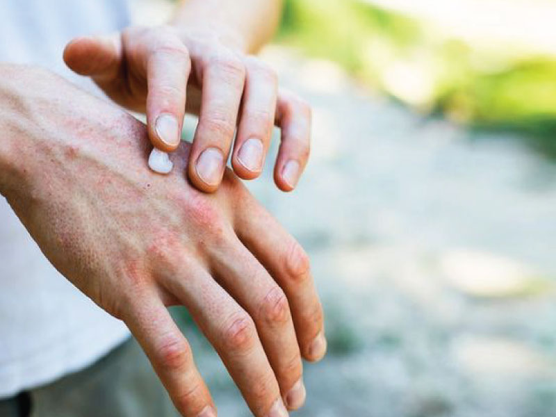 درمان پسوریازیس