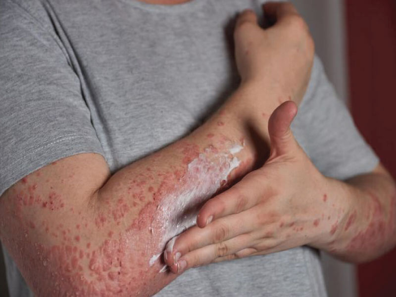 پسوریازیس چیست؟