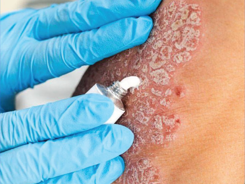درمان های موضعی پسوریازیس