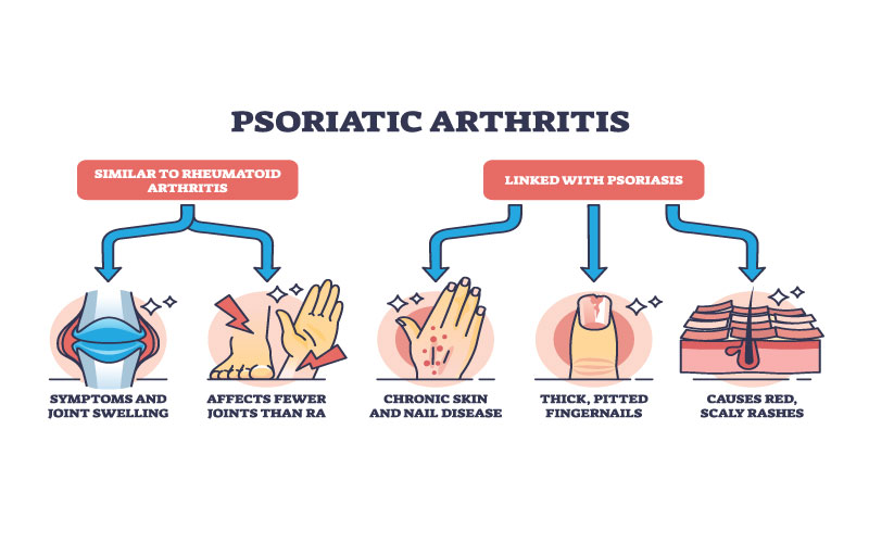 انواع آرتریت پسوریاتیک