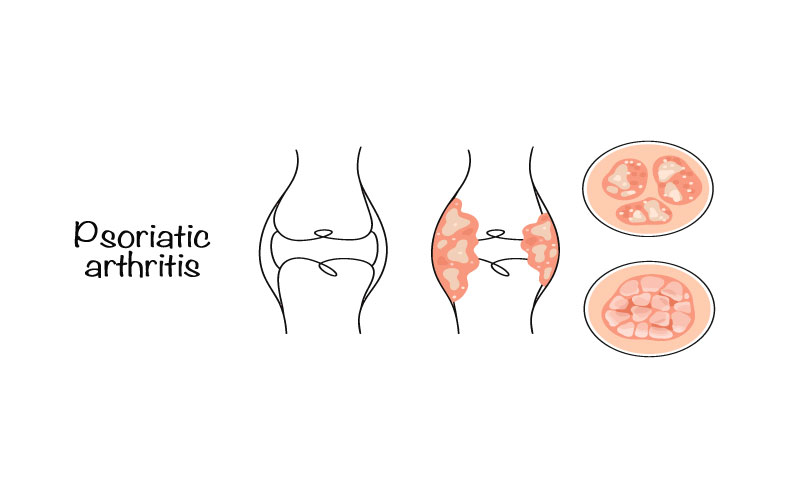 تشخیص آرتریت پسوریاتیک

